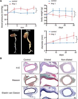 Identification of a biomarker and immune infiltration in perivascular adipose tissue of abdominal aortic aneurysm